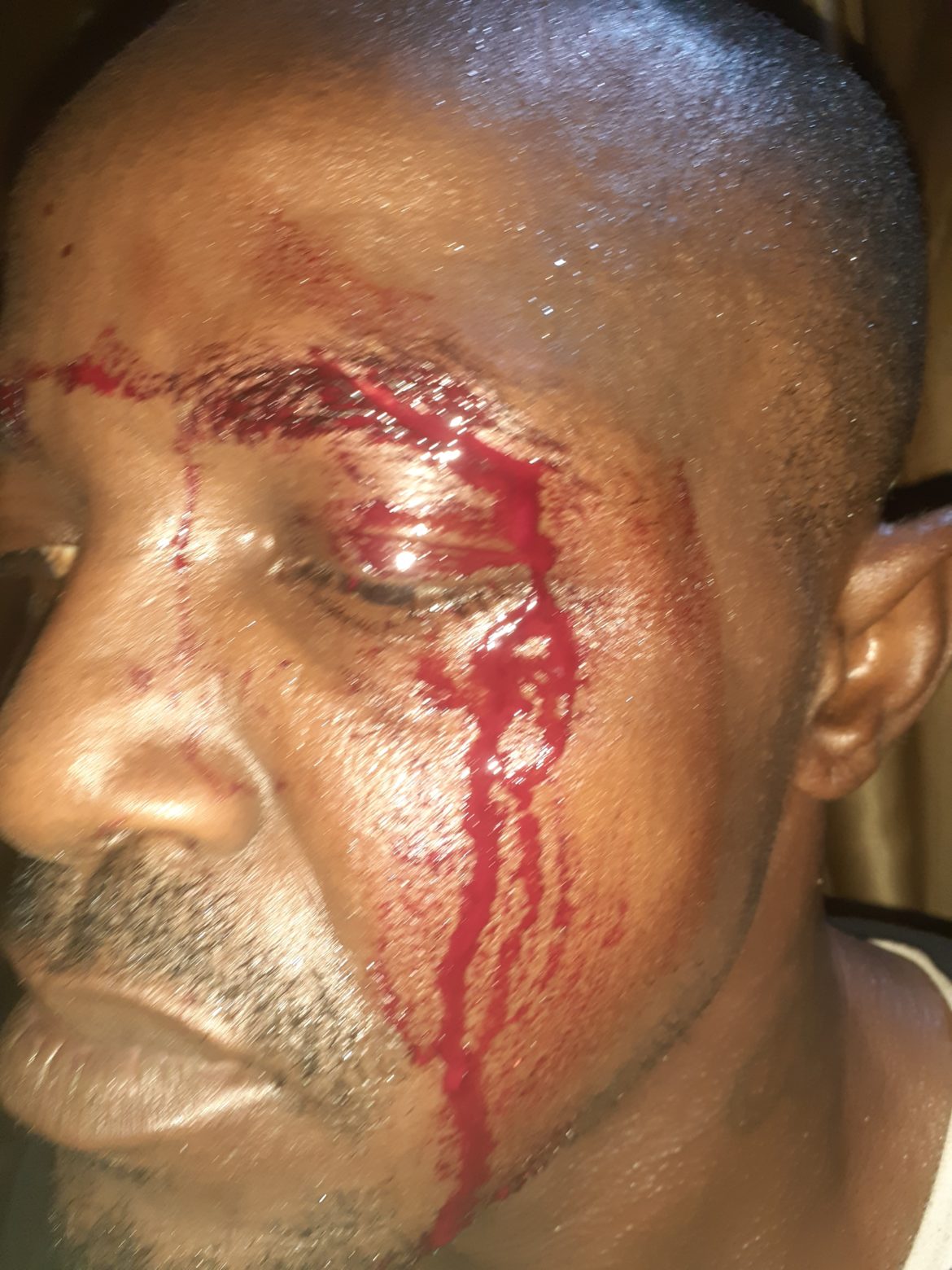 Man gashes neighbor’s eye over argument on toilet usage